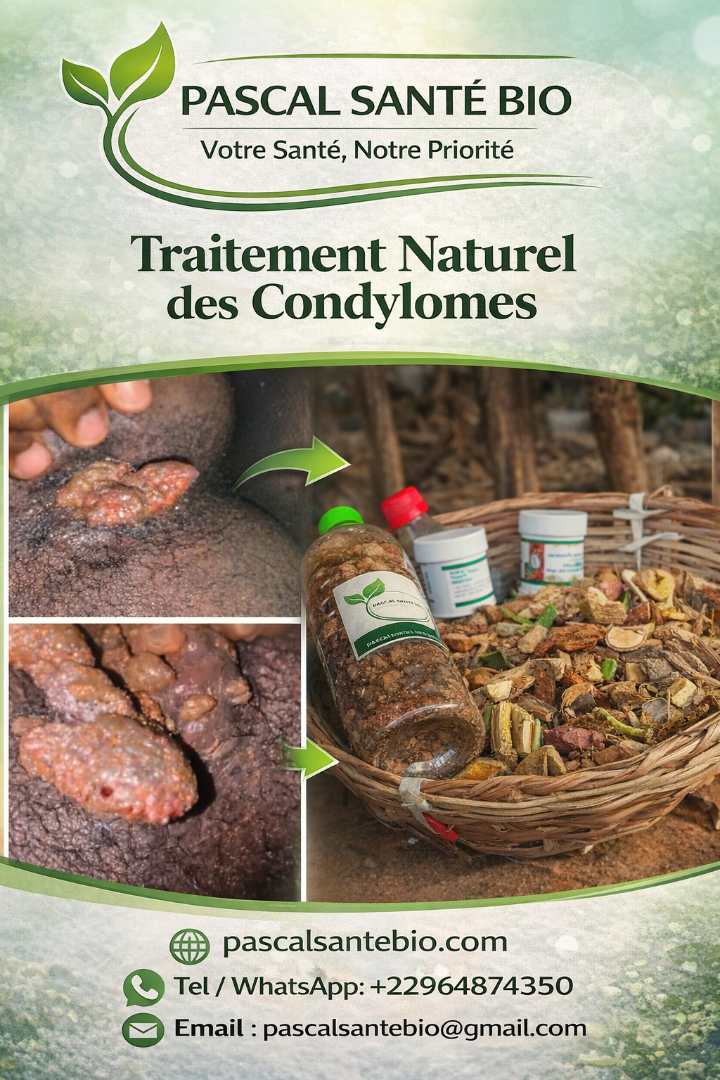 Traiter les condylomes avec les plantes sans chirurgie