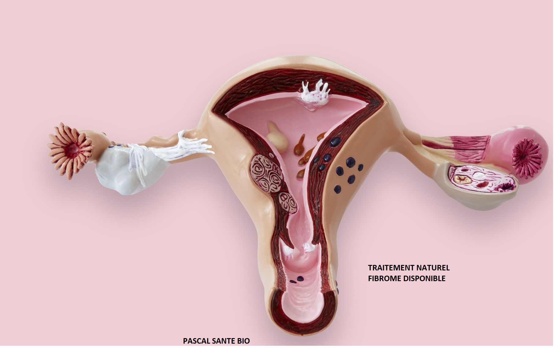 Traitement naturel du fibrome utérin