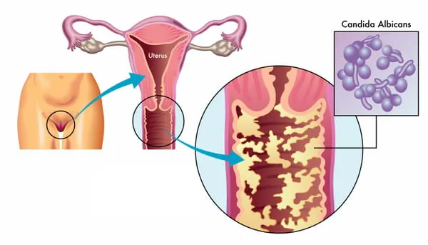 comment traiter la démangeaison vaginale