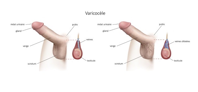 Varicocèle traitement naturel