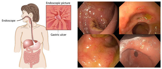 Plaies internes ulcère de l'estomac, ulcère du duodénum ulcère gastroduodénal