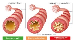 asthmes traitement naturel