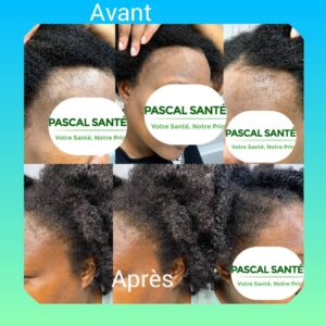 Pascal-HairVital de Pascal Santé Bio: Traiter la calvitie naturellement 