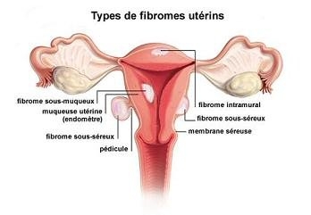 Soigner la fibrome de l'utérus par les plante