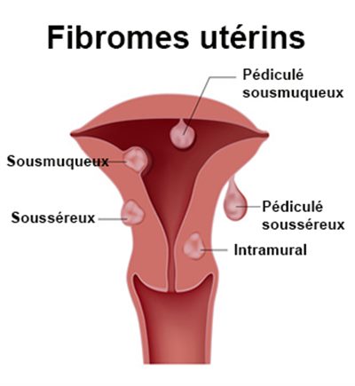 Soigner la fibrome de l'utérus par les plante