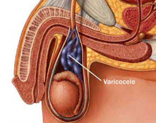 Traiter la varicocèle avec les plante