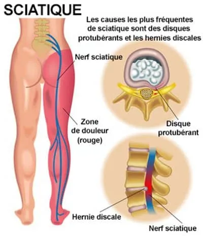 Traitement naturel nerfs et muscles