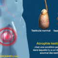 Traitement naturel atrophie testiculaire