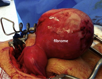 traiter fibrome utérin naturellement