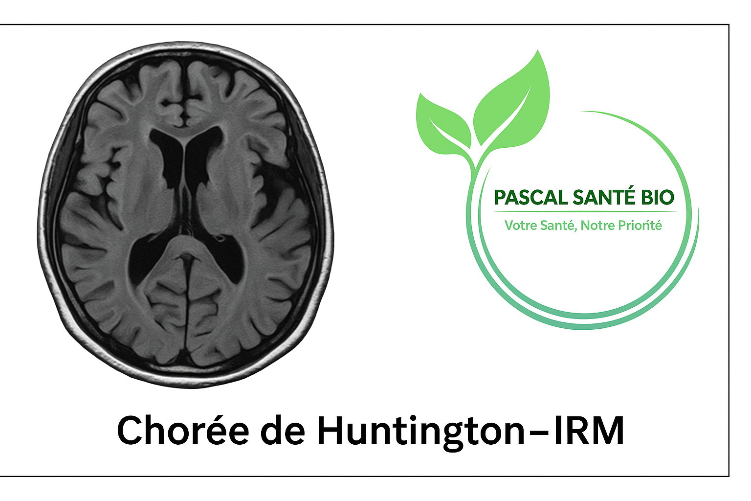 Maladie de Huntington causes et symptômes