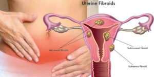Myomes utérins ou fibrome traitement naturel