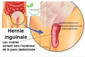 Traitement naturel et définitif de la hernie inguinale