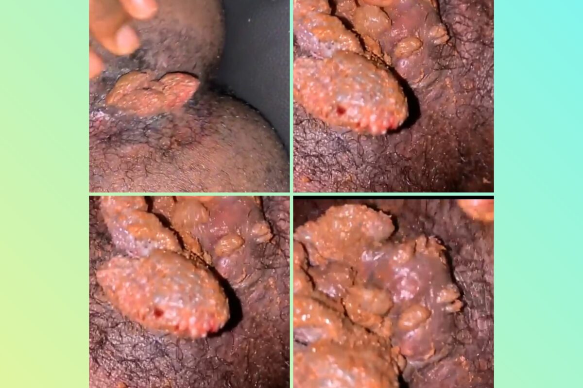 condylome guérir définitivement