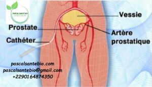 soigner la prostatite naturellement
