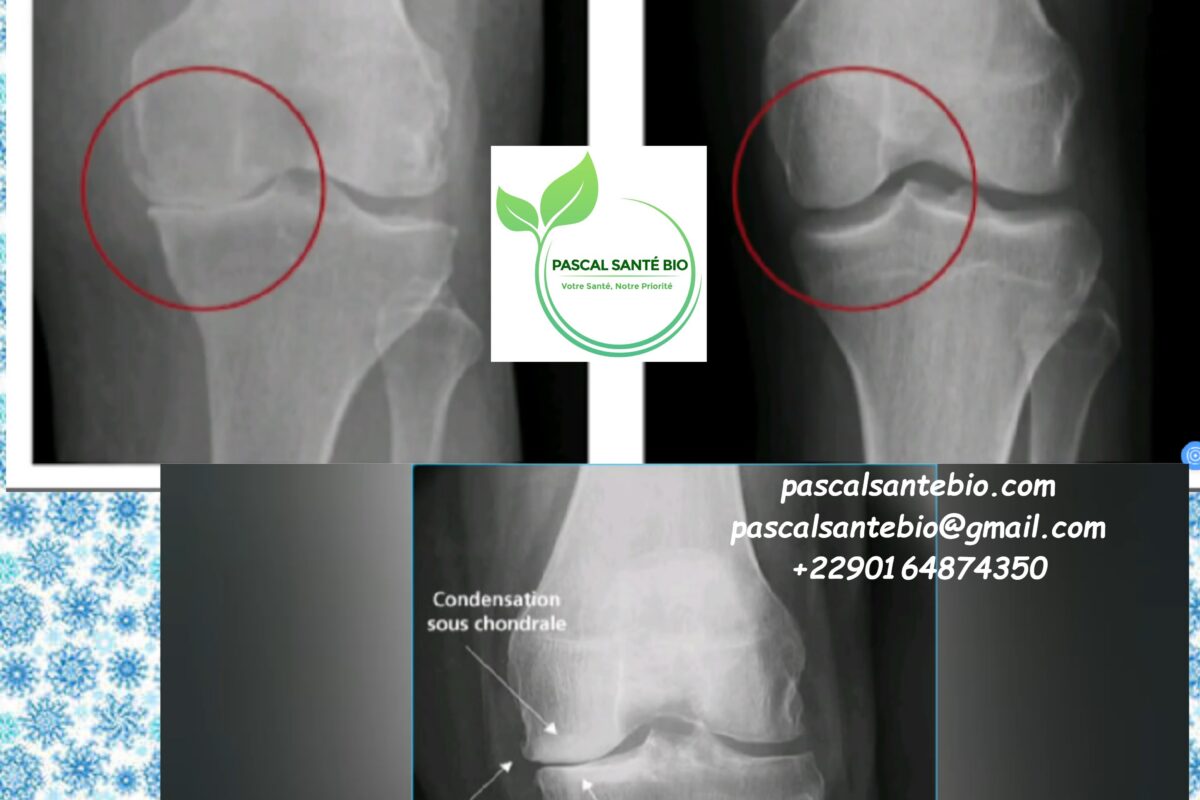 Traitement naturel arthrose