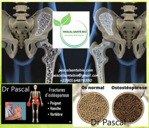 Remède naturel contre ostéoporose