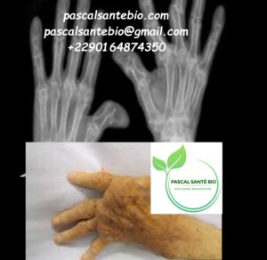 Soigner polyarthrite Rhumatoïde naturellement