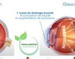 Traiter le glaucome naturellement sans chirurgie