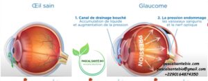 Traiter le glaucome naturellement sans chirurgie