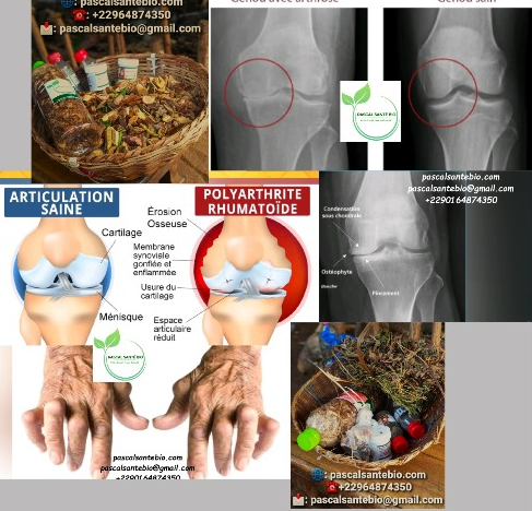 Traiter naturellement l'arthrite et l'arthrose