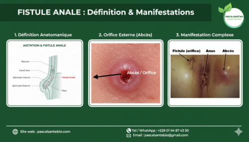 Traiter Fistules anales naturellement: Un patient sur deux ayant une maladie de Crohn souffre de fistules anopérinéales, c'est-à-dire au niveau de l'anus et du périnée. 