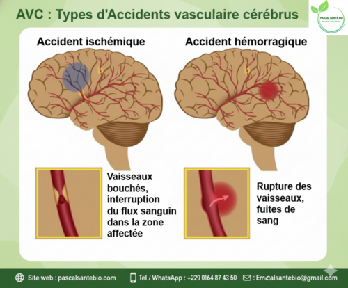 AVC Comprendre et Prévenir l'Attaque Cérébrale