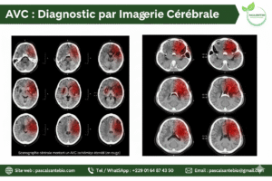 AVC Comprendre et Prévenir l'Attaque Cérébrale