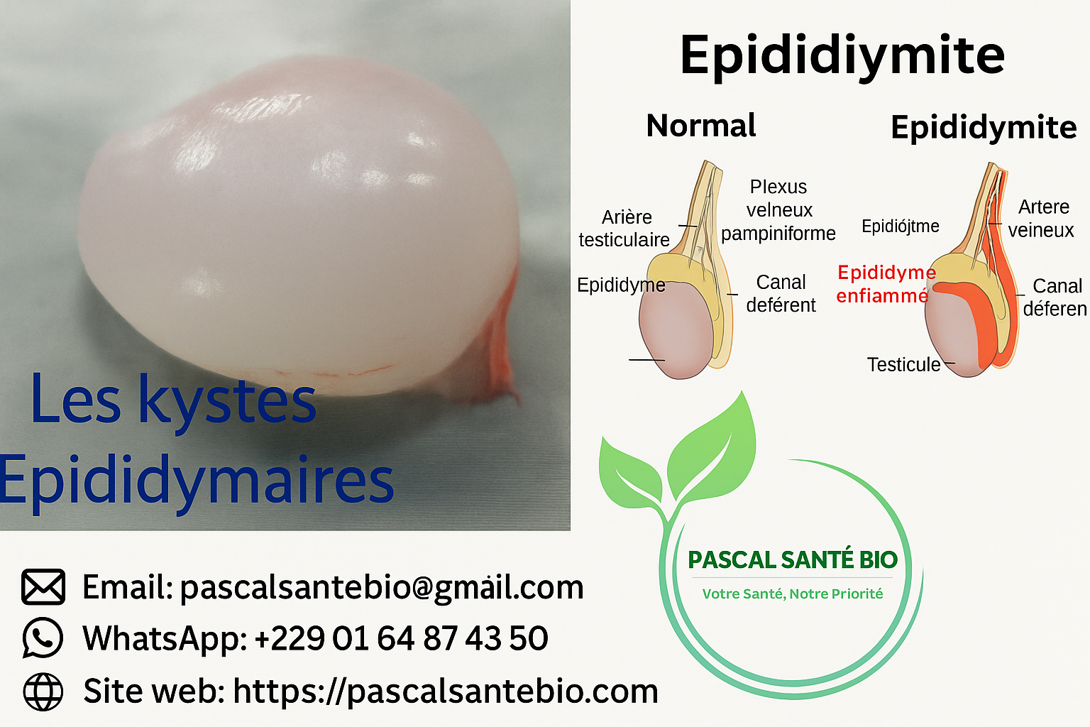 Traiter kystes testiculaire naturellement