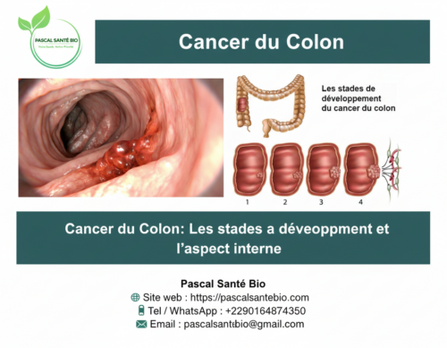 Soigner définitivement cancer colorectal avec les plantes