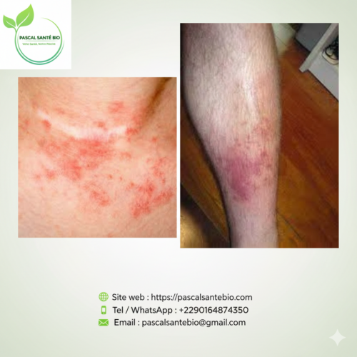 Traitement naturel eczéma