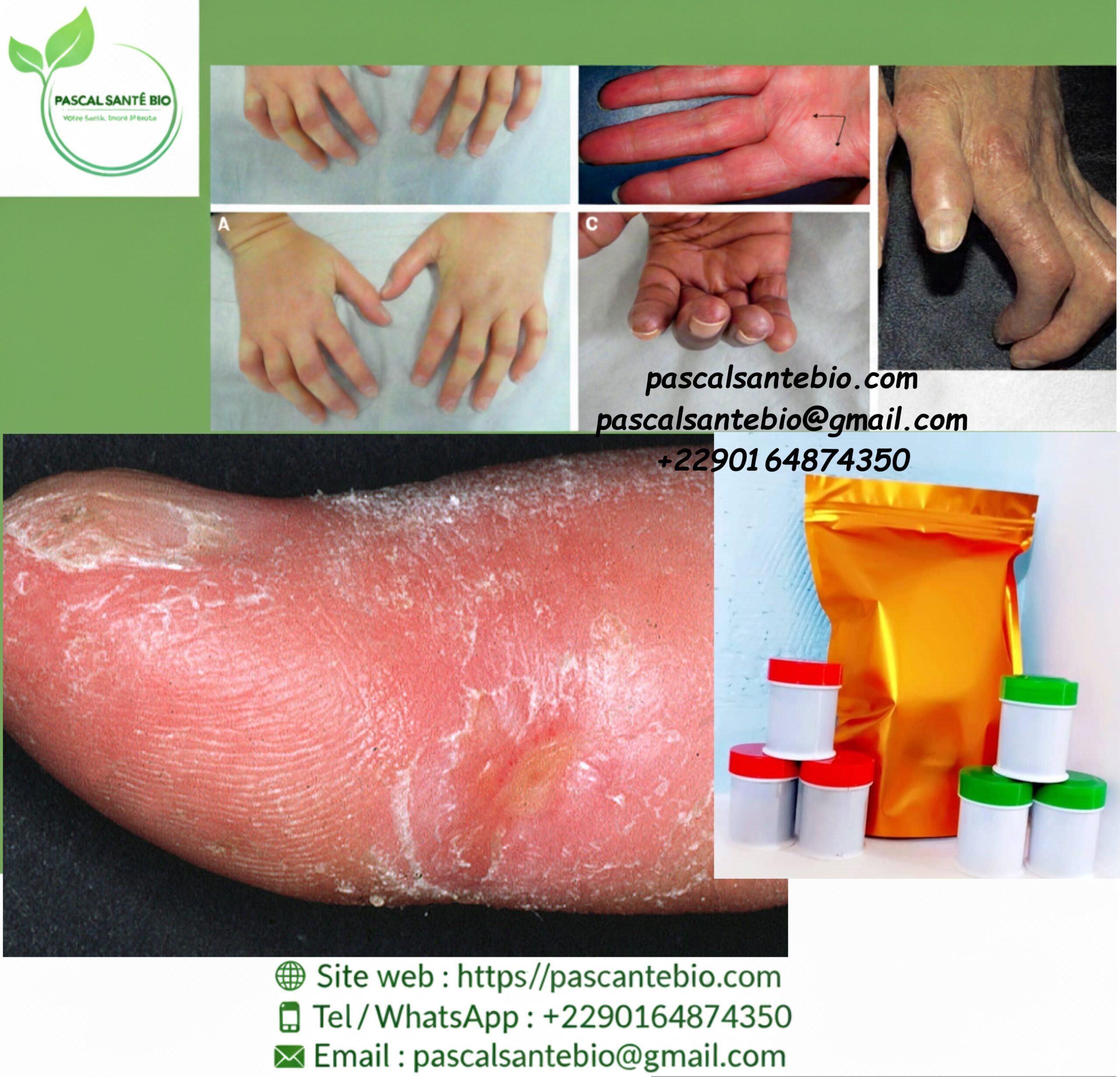 Plantes pour sclérodermie soin bio