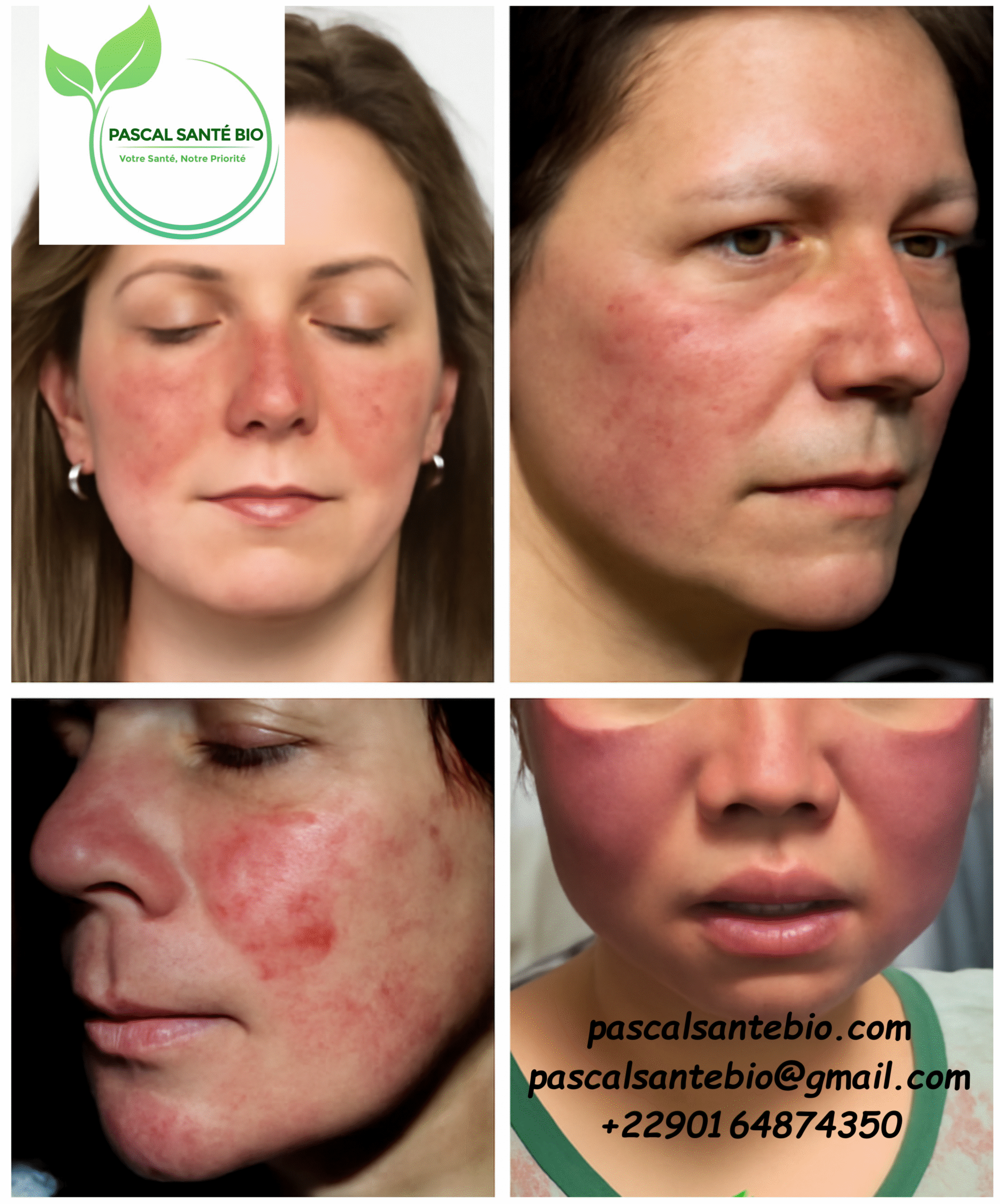 Traitement ou astuce naturellement de lupus