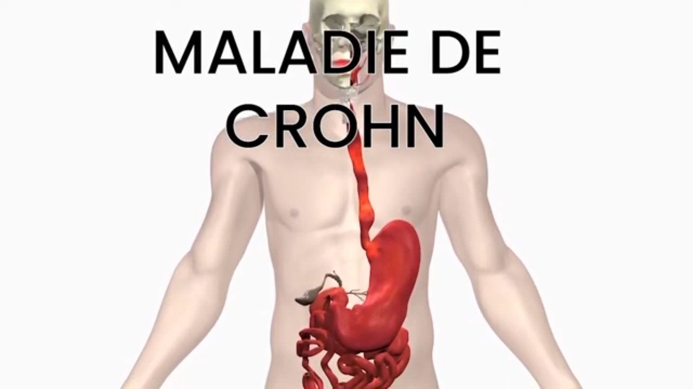 maladie de Crohn traitement naturel