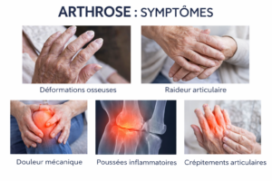 Arthrose Causes et Traitements