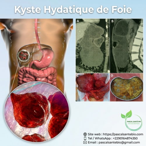 Traitement naturel kyste hépatique