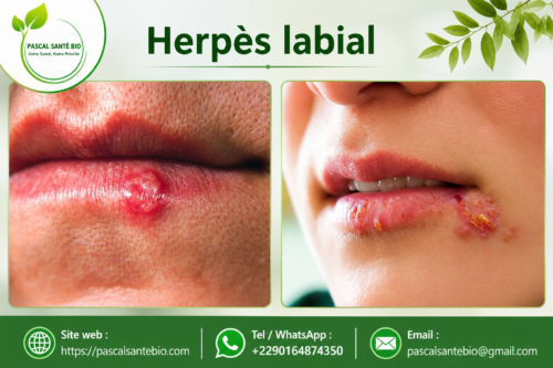 Herpès labial remède naturel